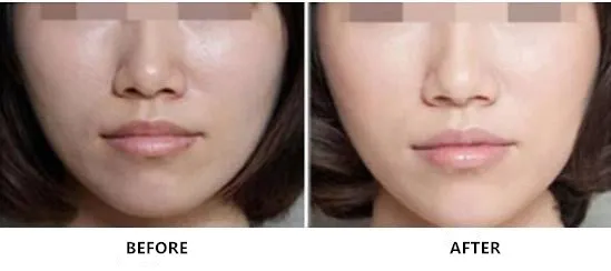 12mg 20mg 36mg 60mg 100mg Non Crosslinked Sodium Hyaluronate Injection Liquid for Whole Face Injection