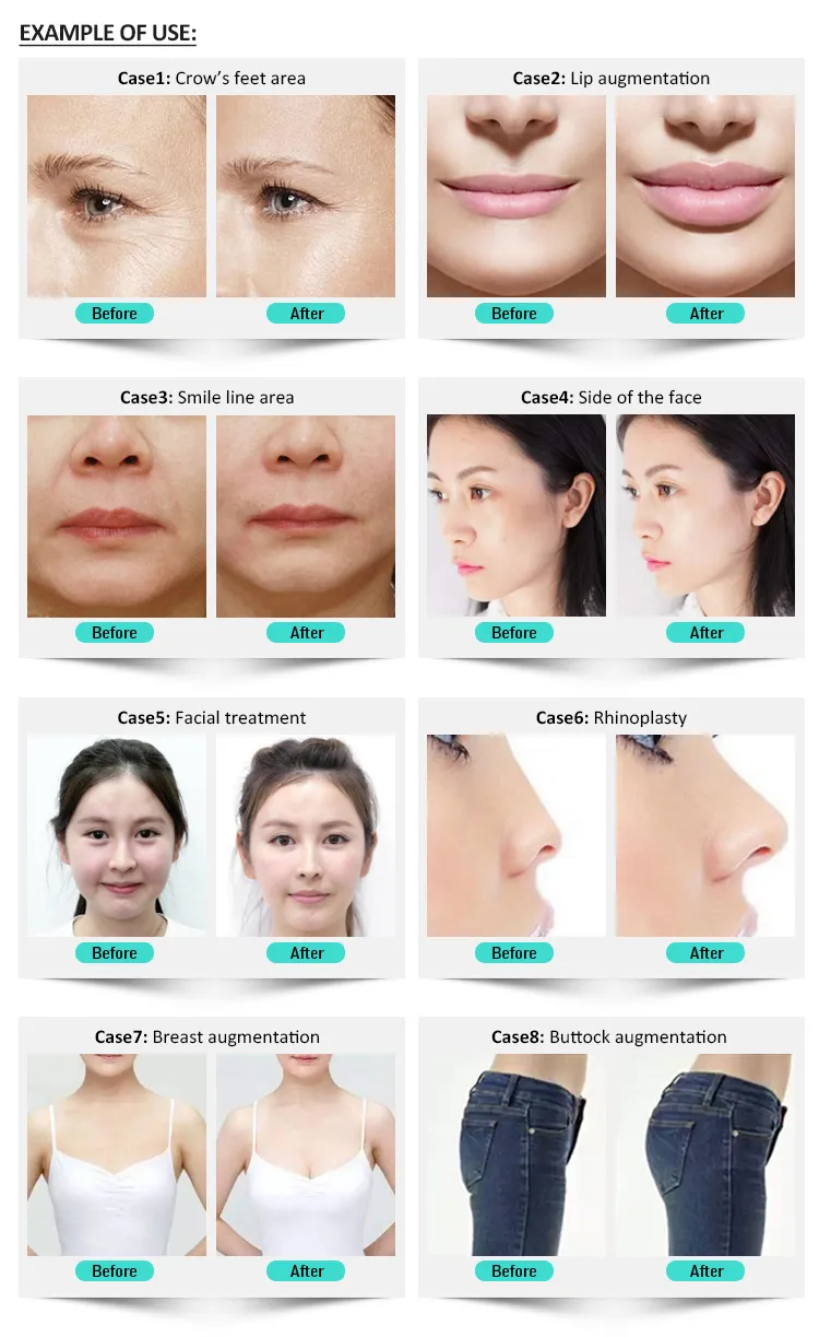 1ml CE Approved Hyaluronic Acid Ha Filler Hyaluronic Acid Korea Dermal Filler for Face