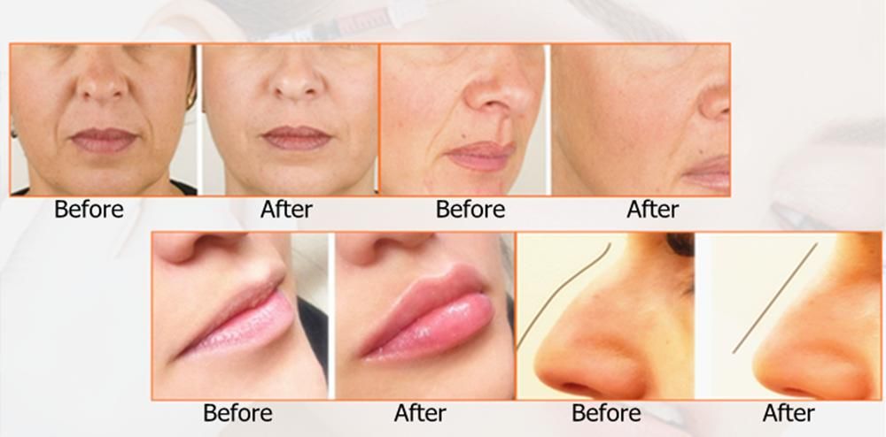 2ml Deep High Quality Hyaluronic Acid Dermal Injection Nose Chin Filler