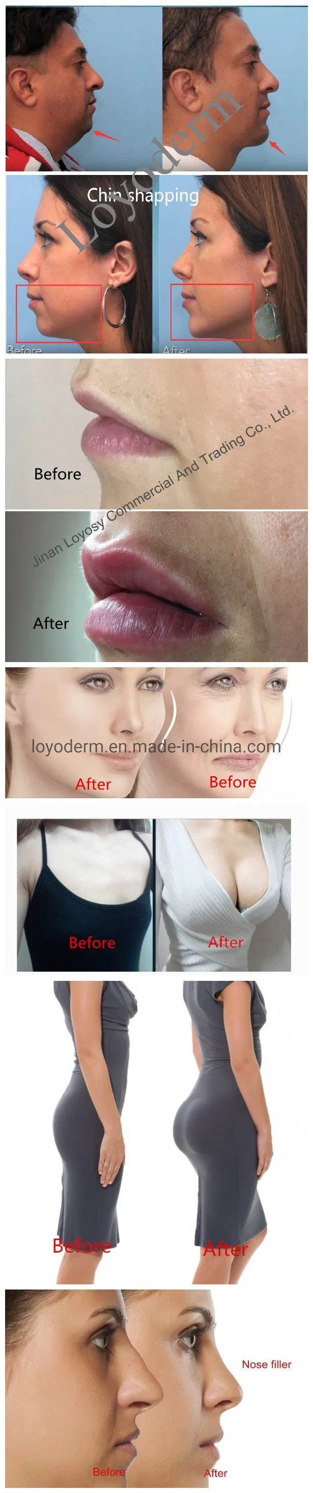 Anti Adhesive Gel Hyaluronic Acid Gel for Abdominal and Pelvic Surgery