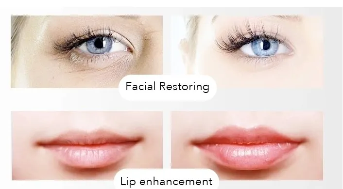 CE Approved Singfiller Dermal Filler Hyaluronic Acid Injection