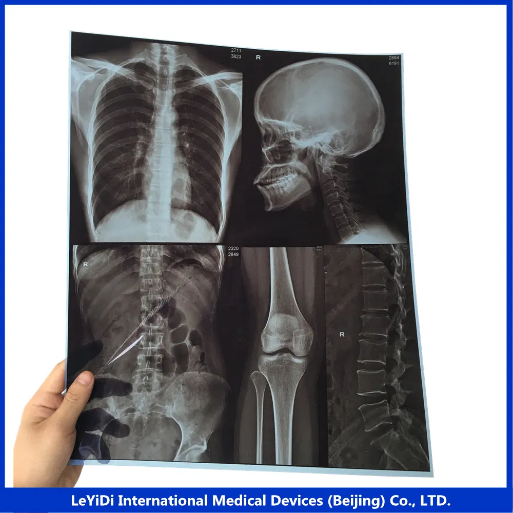 Digital Chest X-ray Films/Image for Hospital