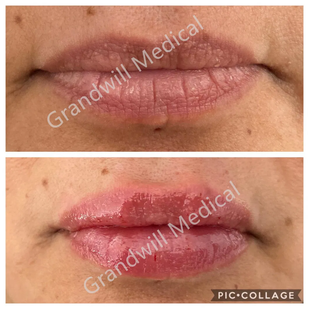 Hyaluronic Acid Dermal Fillers for Chin Area Sagging Jowls Injection Sodium Hyaluronate Gel