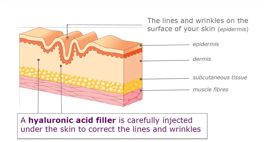 Hyaluronic Acid Ha Gel Filer Injections for Men Enlargment Penis
