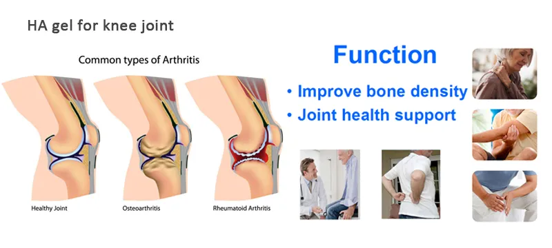 Intra-Articular Hyaluronic Acid Injection Gel in The Knee Joints for Osteoarthritis Injection