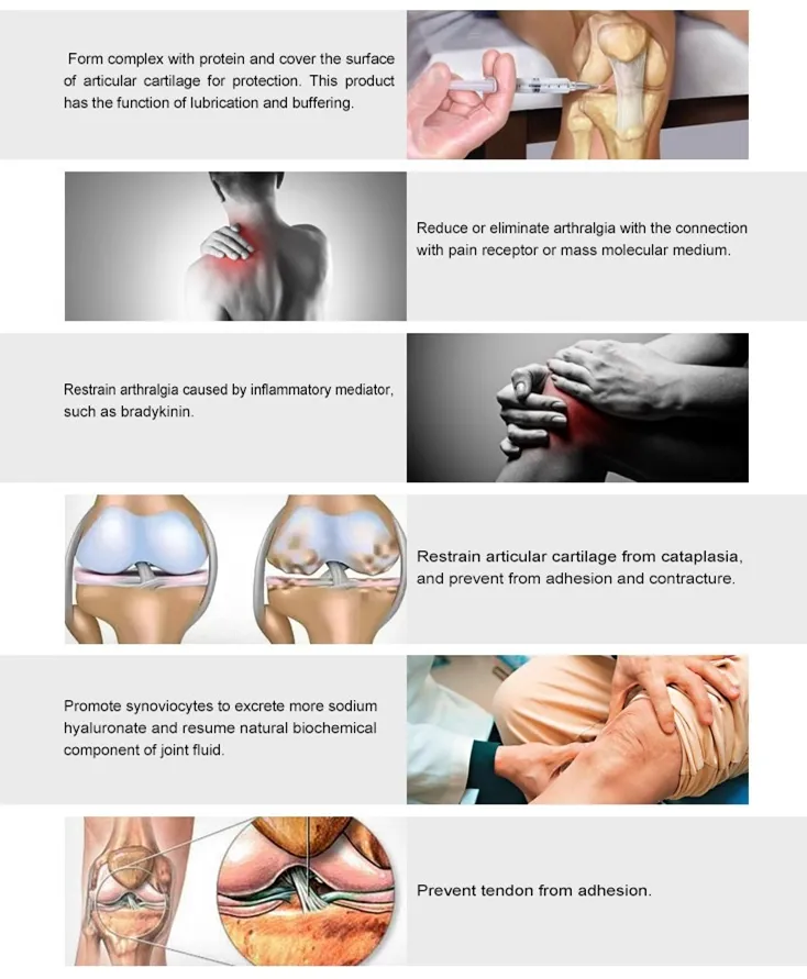 Intra-Articular Hyaluronic Acid Injection Gel in The Knee Joints for Osteoarthritis Injection