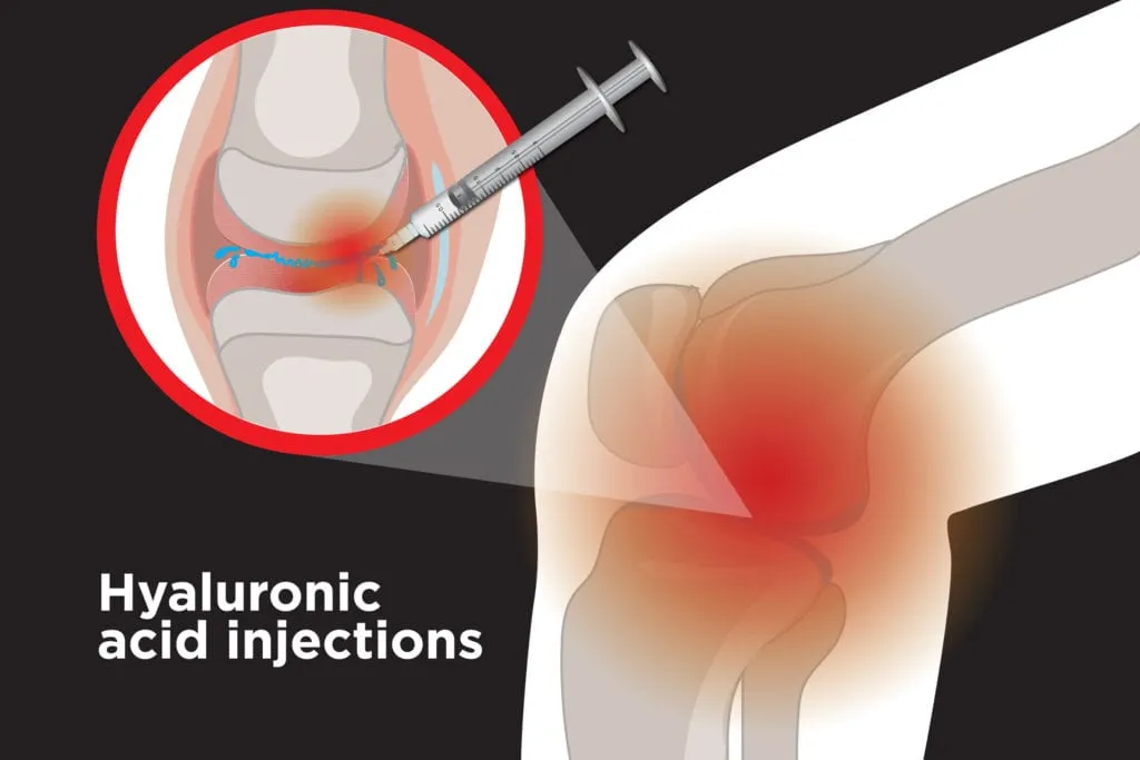 Intra-Articular Hyaluronic Acid Injection Gel in The Knee Joints for Osteoarthritis Injection
