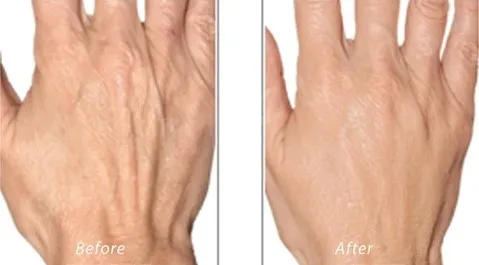 Jealifill Wholesale Price Anti Wrinkles Face Cheek Nose Chin Filler Hyaluronic Acid Dermal Filler