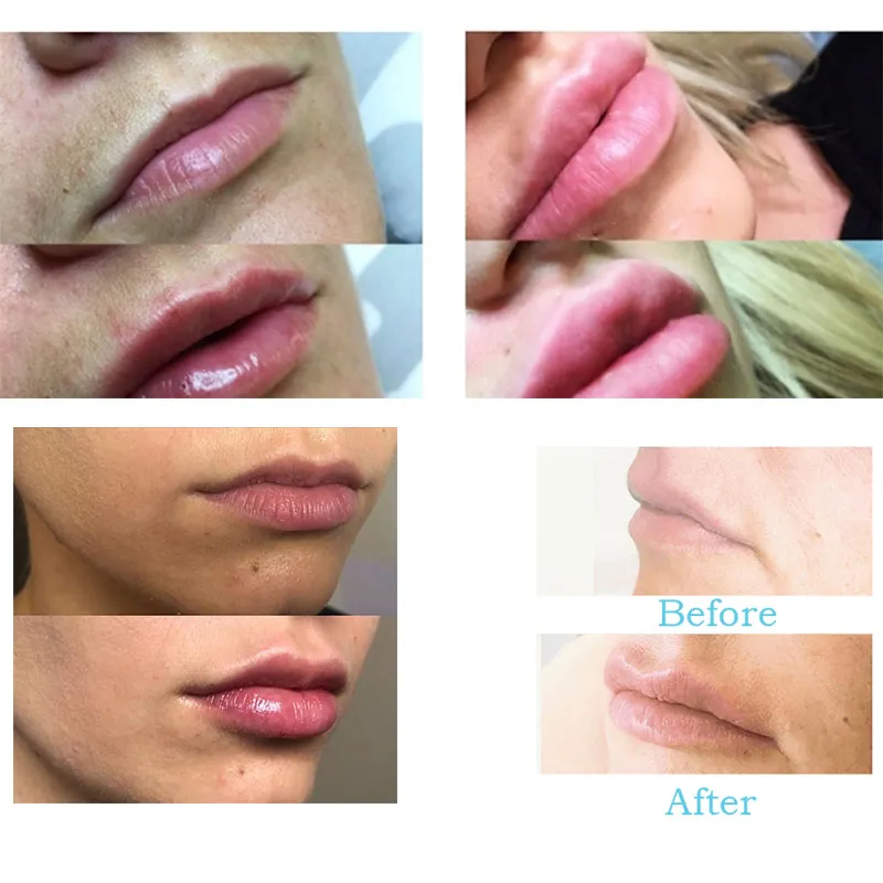 Long Lastingha Dermal Filer Hyaluronic Acid Filler for Face, Lips 5ml Dermal Filler for Lip Fullness