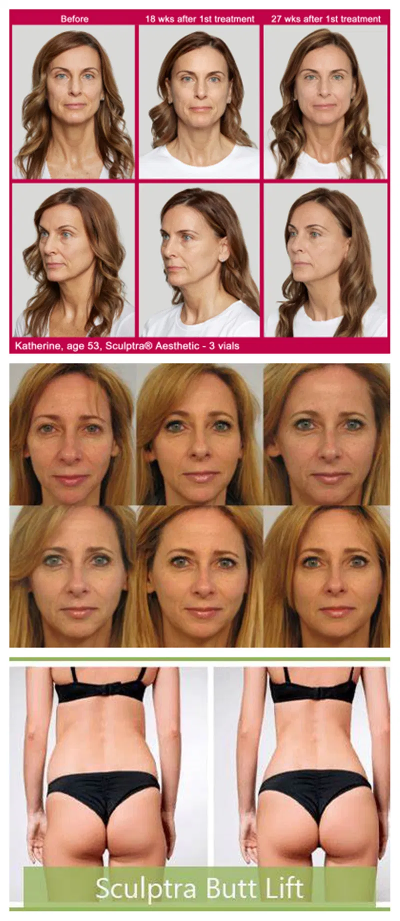 Sculptra Breast Injection Plla Acid Demal Filler